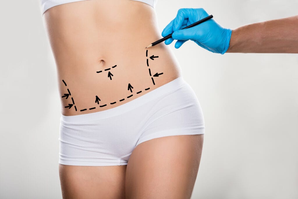 Close up,Of,A,Surgeon,Drawing,Correction,Lines,On,Woman's,Stomach